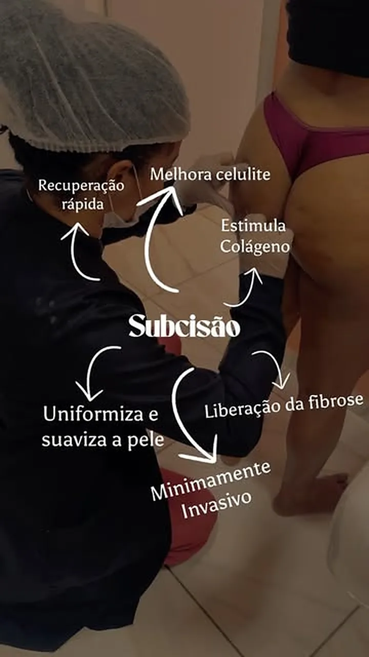 Subcisão