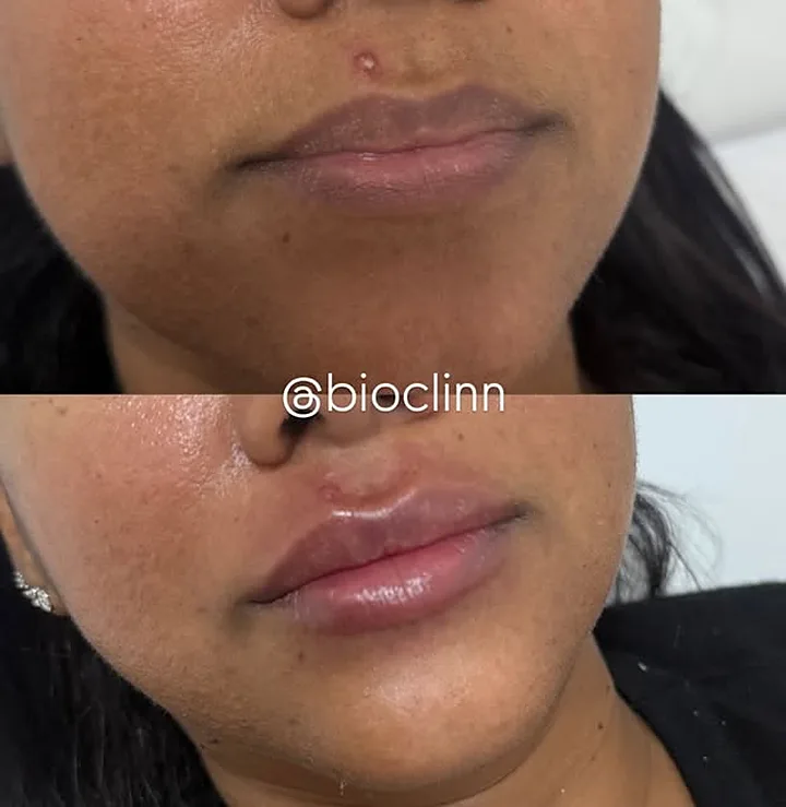 Preenchimento labial