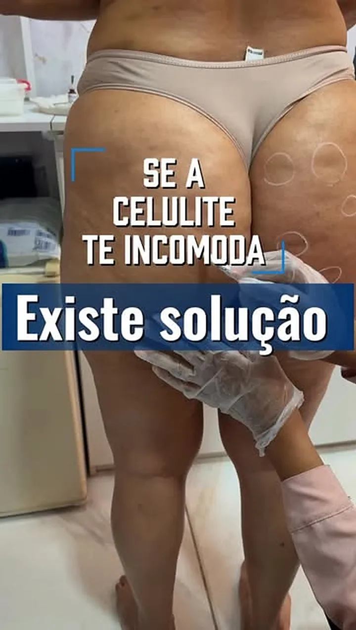 Post sobre tratamento de celulite da Bioclin